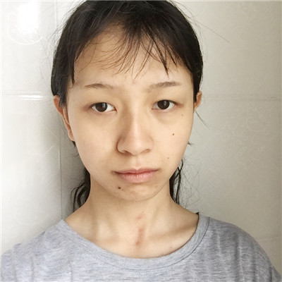 上海凯瑞张立平眼部综合怎么样?案例分享