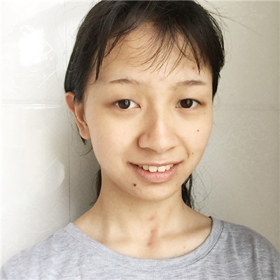上海凯瑞张立平眼部综合怎么样?案例分享
