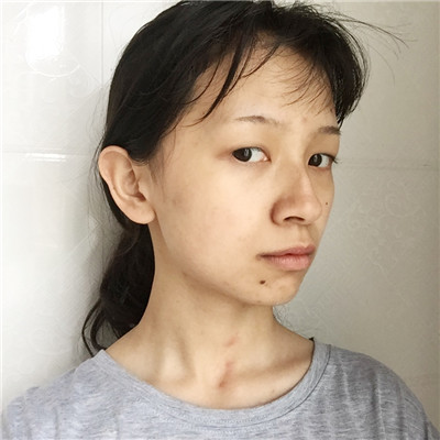 上海凯瑞张立平眼部综合怎么样?案例分享