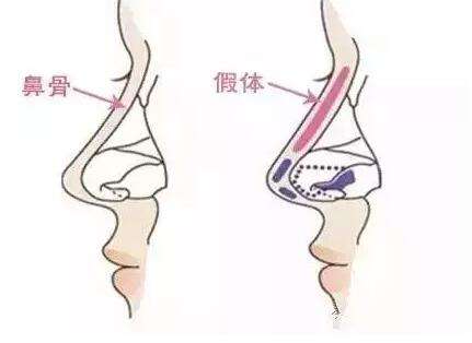 假体隆鼻后有哪些注意事项?