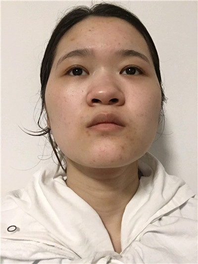 厦门颜施童晋文鼻部手术怎么样?案例分享
