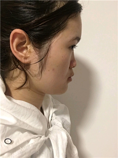 厦门颜施童晋文鼻部手术怎么样?案例分享