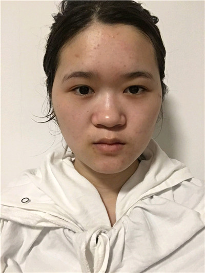 厦门颜施童晋文鼻部手术怎么样?案例分享