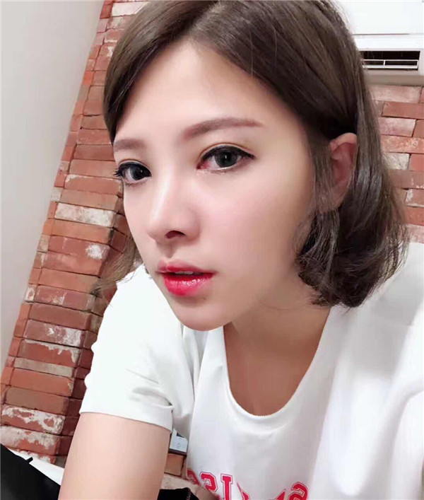重庆联合丽格双眼皮怎么样?价格案例492天