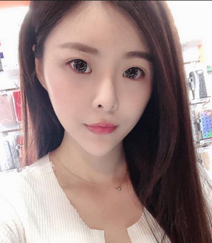 常州美贝尔鼻部手术怎么样?价格案例96天