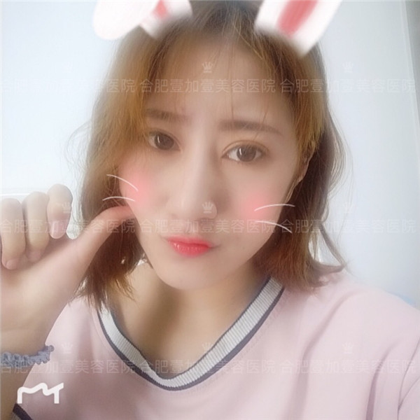 合肥壹加壹眼部手术怎么样?价格案例107天
