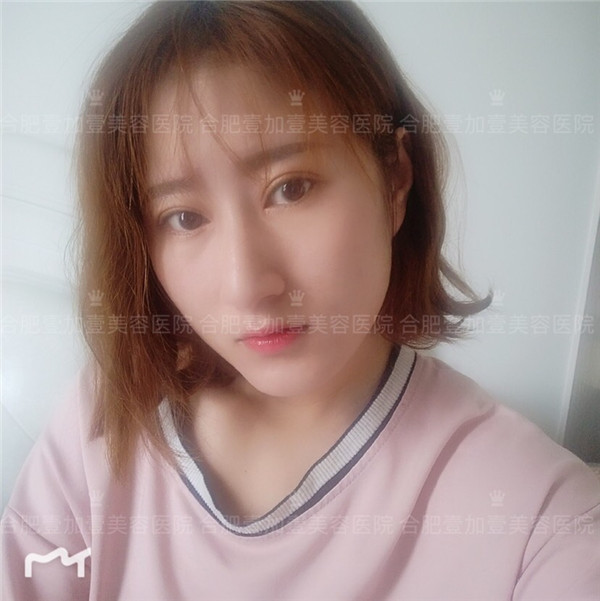 合肥壹加壹眼部手术怎么样?价格案例107天