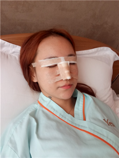 北京联合丽格师俊莉鼻部手术怎么样?案例分享
