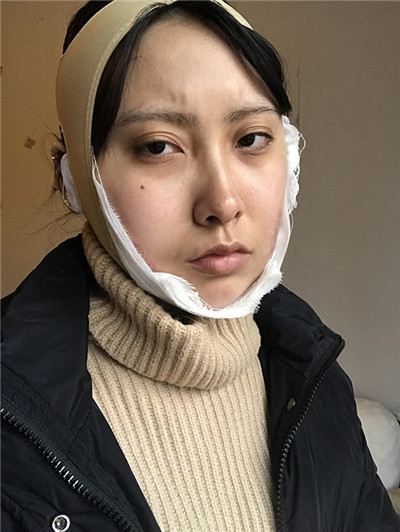 重庆万家燕王珍祥下颌角怎么样?案例分享