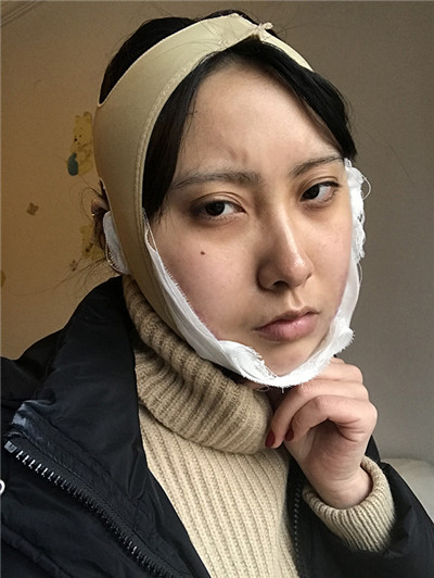 重庆万家燕王珍祥下颌角怎么样?案例分享