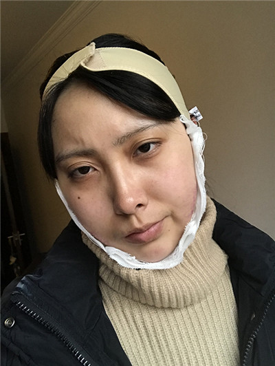 重庆万家燕王珍祥下颌角怎么样?案例分享