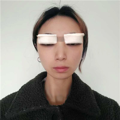 山西省整形外科刘晋元切开双眼皮怎么样?案例分享
