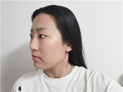 兰州亚韩医学李军梅鼻部手术怎么样?案例分享