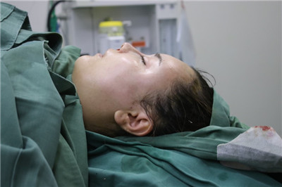 台州维多利亚艾长安鼻部手术怎么样?案例分享
