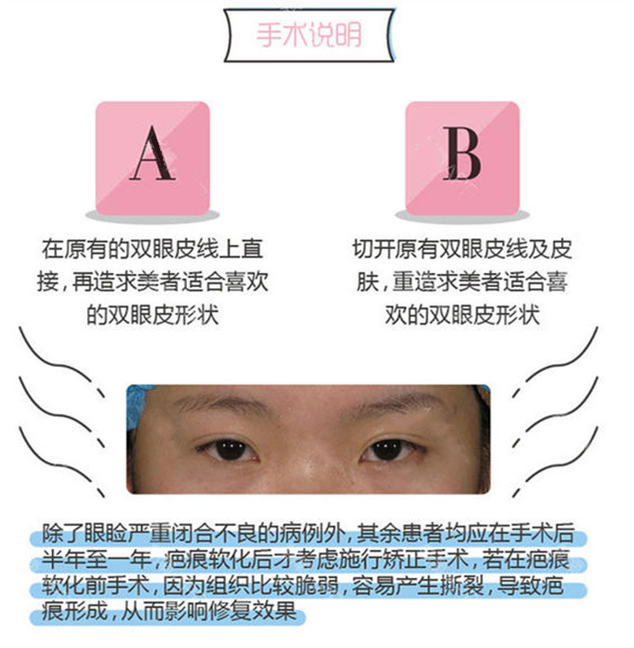 南京友谊做双眼皮修复眼角疤痕修复怎么样?