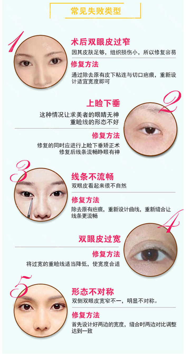 南京友谊做双眼皮修复眼角疤痕修复怎么样?