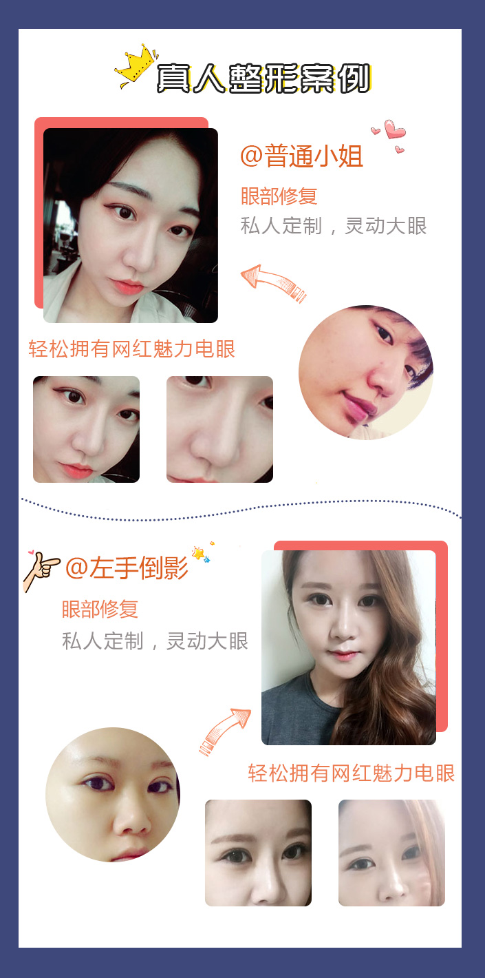 南京友谊做双眼皮修复眼角疤痕修复怎么样?