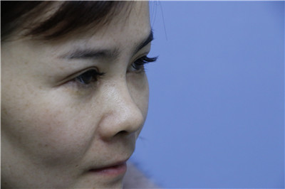 杭州时光胡斌鼻部手术怎么样?案例分享
