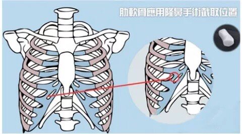 耳软骨和肋软骨隆鼻有什么区别?