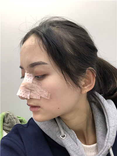 重庆铂生杜亚旭肋软骨隆鼻怎么样?案例分享