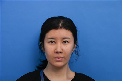 大连瑞和杨柠泽鼻部手术怎么样?案例分享