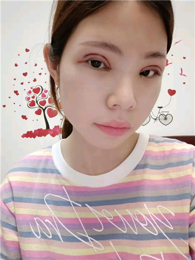 郑州东方黄军伟眼部综合怎么样?案例分享