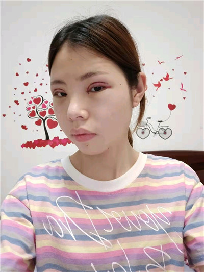 郑州东方黄军伟眼部综合怎么样?案例分享
