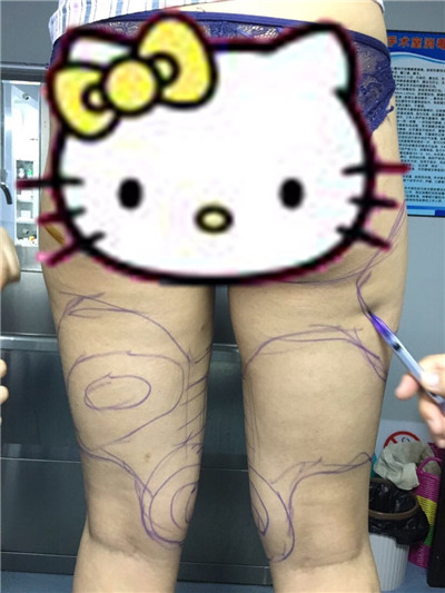 哈尔滨韩美于兆松吸脂瘦大腿怎么样?案例分享