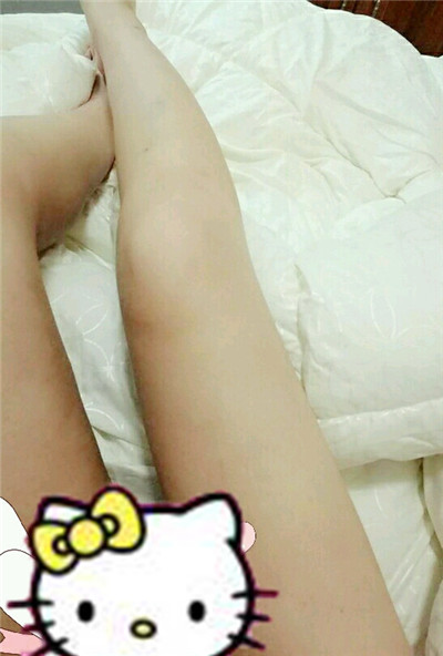 哈尔滨韩美于兆松吸脂瘦大腿怎么样?案例分享
