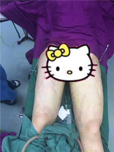 哈尔滨韩美于兆松吸脂瘦大腿怎么样?案例分享