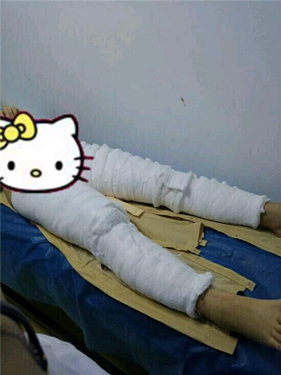 哈尔滨韩美于兆松吸脂瘦大腿怎么样?案例分享