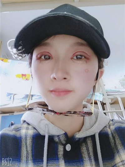 太原美媛荟冯瑞铮切开双眼皮怎么样?案例分享