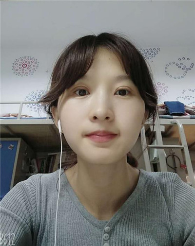 太原美媛荟冯瑞铮切开双眼皮怎么样?案例分享