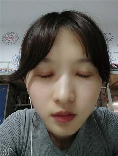 太原美媛荟冯瑞铮切开双眼皮怎么样?案例分享