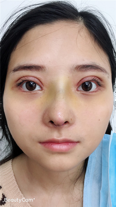 德阳金荣王玉洁鼻部手术怎么样?案例分享