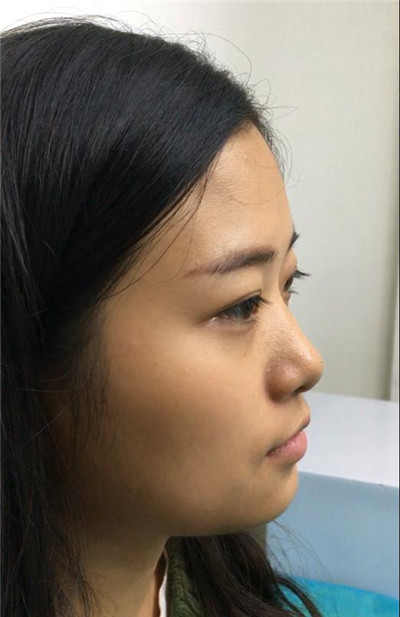 德阳金荣王玉洁鼻部手术怎么样?案例分享