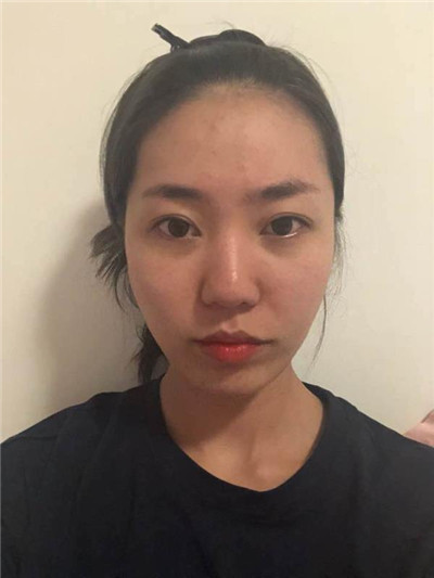 郑州芳艺杨伟鼻部手术怎么样?案例分享