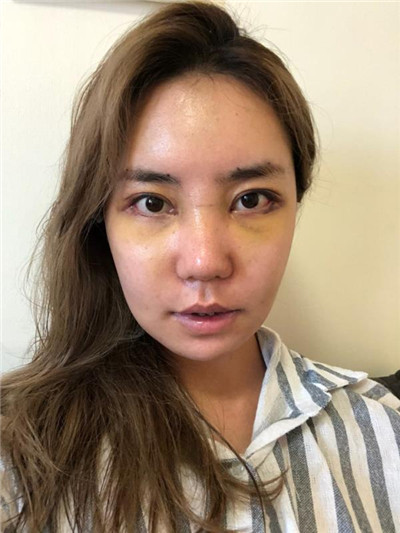 郑州芳艺杨伟鼻部手术怎么样?案例分享