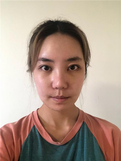 郑州芳艺杨伟鼻部手术怎么样?案例分享