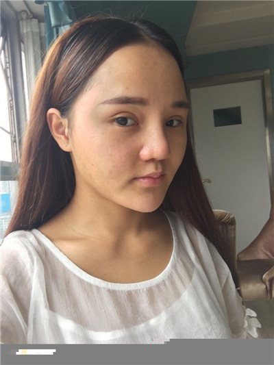 珠海科美张民望硅胶隆鼻怎么样?案例分享