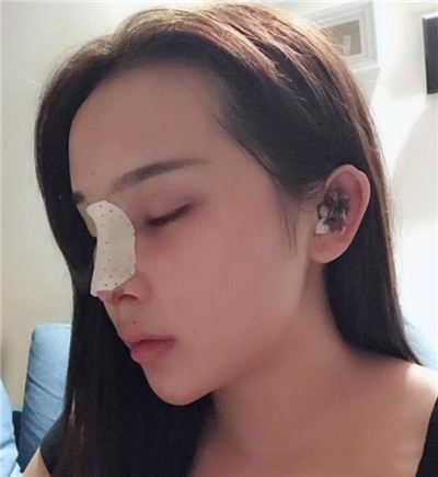 西安亚太谢劲松鼻部手术怎么样?案例分享