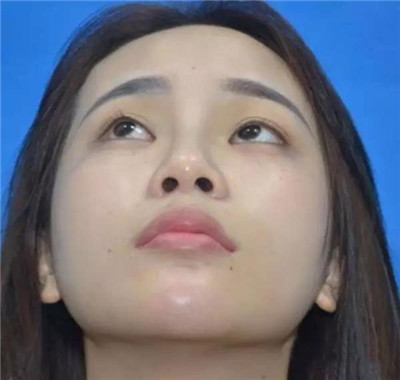 西安亚太谢劲松鼻部手术怎么样?案例分享