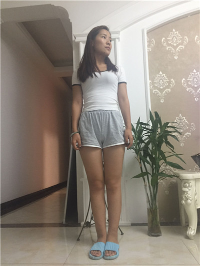 杭州时光黄良飞吸脂瘦大腿怎么样?案例分享