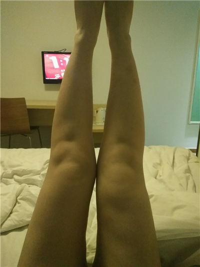 杭州时光黄良飞吸脂瘦大腿怎么样?案例分享