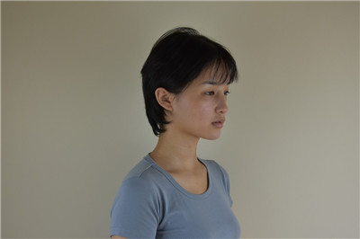 长沙你美彭文胜耳软骨复合隆鼻怎么样?案例分享