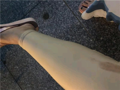 深圳美芮王权吸脂瘦全身怎么样?案例分享