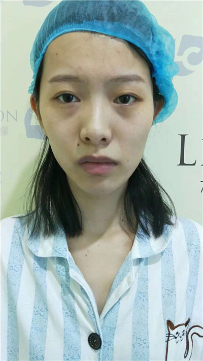 南京柠檬朱晓波鼻部手术怎么样?案例分享