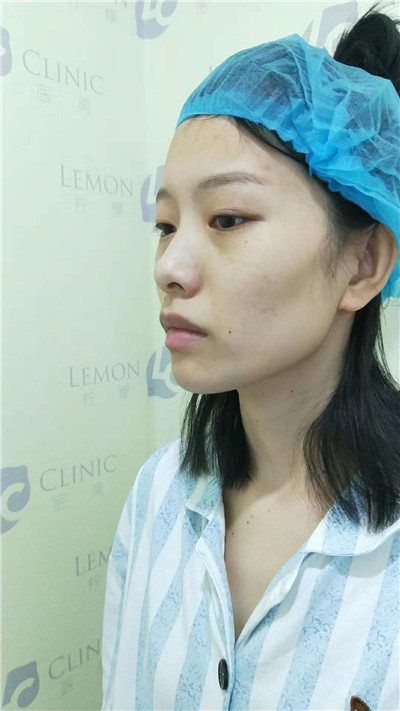 南京柠檬朱晓波鼻部手术怎么样?案例分享