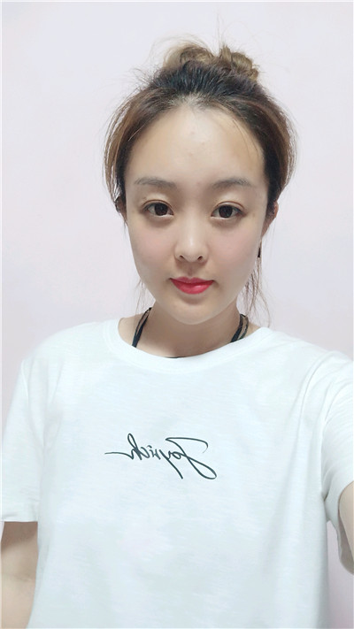 黑龙江瑞丽杨永胜自体脂肪全脸填充怎么样?案例分享