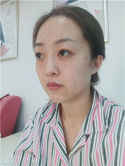 黑龙江瑞丽杨永胜自体脂肪全脸填充怎么样?案例分享